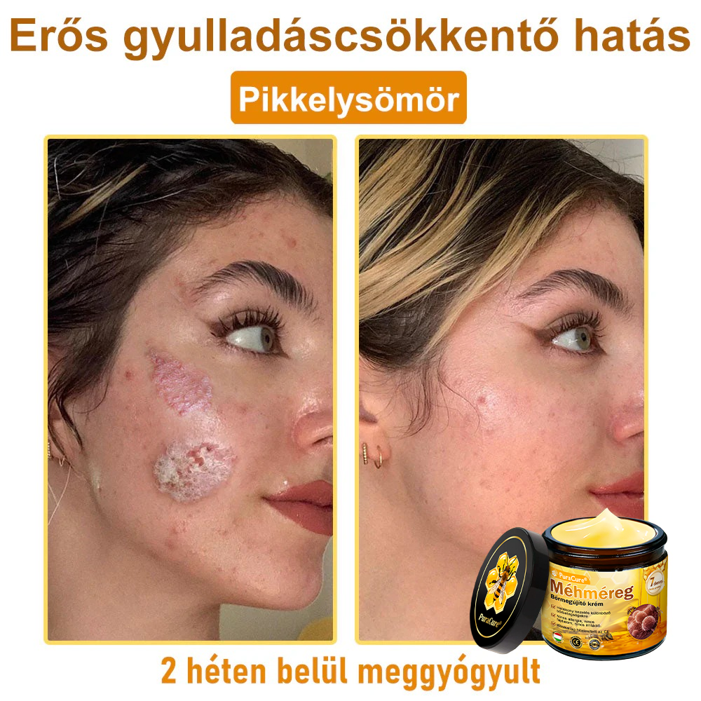 🛡️ 𝐏𝐮𝐫𝐚𝐂𝐮𝐫𝐞® 𝐌é𝐡𝐦é𝐫𝐞𝐠 𝐁ő𝐫 𝐇𝐞𝐥𝐲𝐫𝐞á𝐥𝐥í𝐭ó 𝐊𝐫é𝐦 (👨‍⚕‍𝐂𝐄 𝐓𝐚𝐧ú𝐬í𝐭𝐯á𝐧𝐲)👍✅