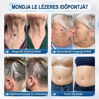 💖PuraCure® 👩‍⚕️ 𝟕 𝐍𝐚𝐩𝐨𝐬 Bőrkinövés- és Folteltávolító Toll Fájdalommentes és Hegmentes Professzionális Rollerball