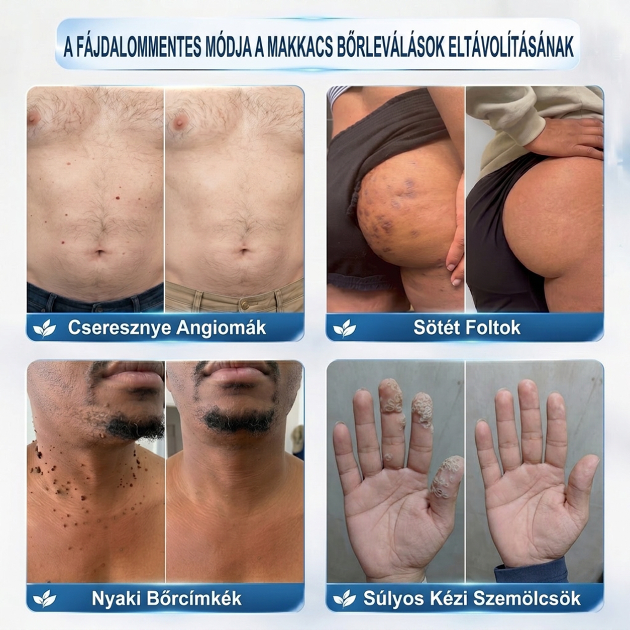 💖PuraCure® 👩‍⚕️ 𝟕 𝐍𝐚𝐩𝐨𝐬 Bőrkinövés- és Folteltávolító Toll Fájdalommentes és Hegmentes Professzionális Rollerball