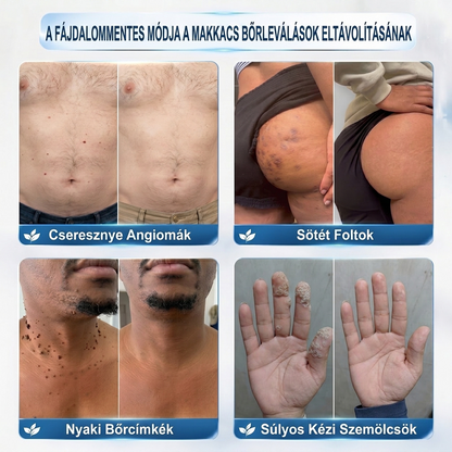 💖PuraCure® 👩‍⚕️ 𝟕 𝐍𝐚𝐩𝐨𝐬 Bőrkinövés- és Folteltávolító Toll Fájdalommentes és Hegmentes Professzionális Rollerball