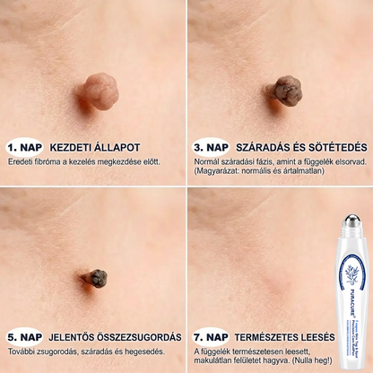 💖PuraCure® 👩‍⚕️ 𝟕 𝐍𝐚𝐩𝐨𝐬 Bőrkinövés- és Folteltávolító Toll Fájdalommentes és Hegmentes Professzionális Rollerball