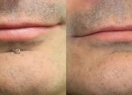 👉 PuraCure® 2 az 1-ben mikrotűs és hidrokolloid tapasz🧑‍⚕️ | Kiálló anyajegyek, aknék, lapos szemölcsök és bőrnövedékek eltávolítására | Segít csökkenteni a ráncokat, hegeket és bőrhibákat | Láthatatlan tapasz az arcra és testre