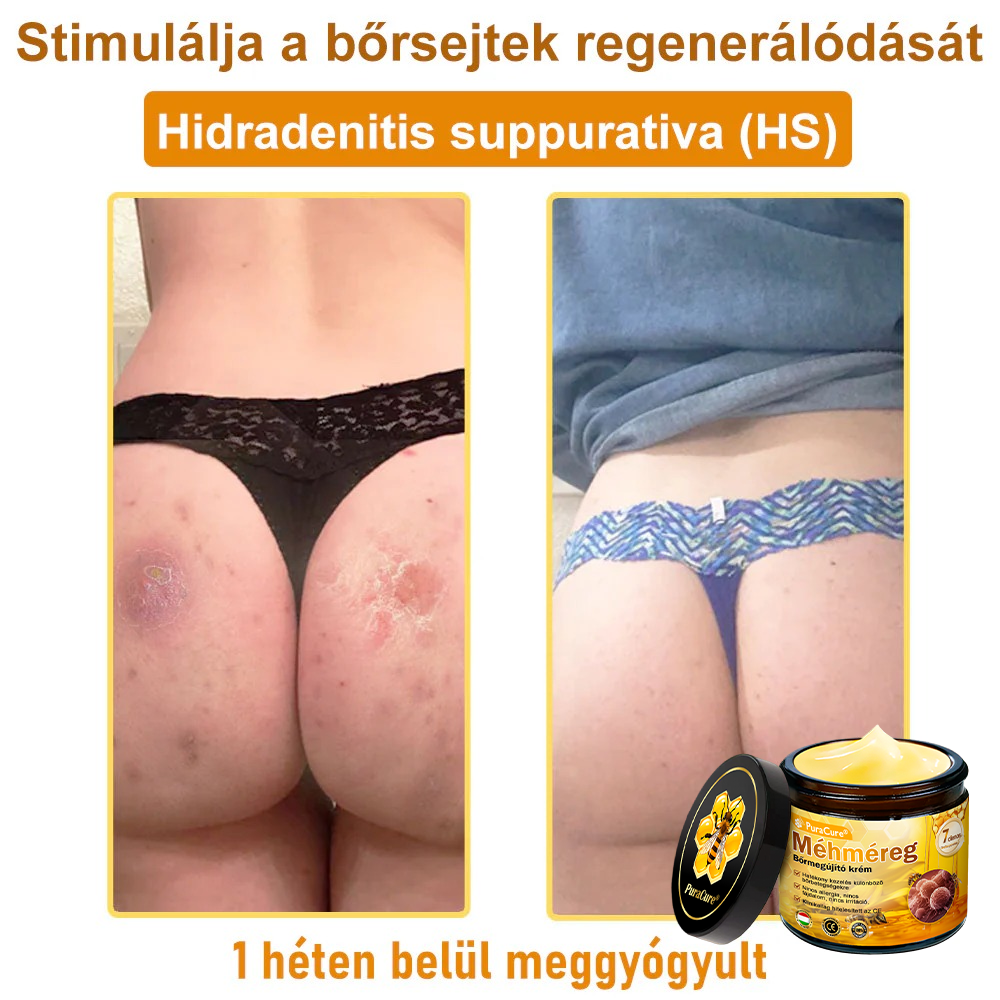 🛡️ 𝐏𝐮𝐫𝐚𝐂𝐮𝐫𝐞® 𝐌é𝐡𝐦é𝐫𝐞𝐠 𝐁ő𝐫 𝐇𝐞𝐥𝐲𝐫𝐞á𝐥𝐥í𝐭ó 𝐊𝐫é𝐦 (👨‍⚕‍𝐂𝐄 𝐓𝐚𝐧ú𝐬í𝐭𝐯á𝐧𝐲)👍✅