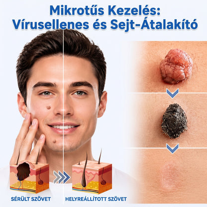 👉 PuraCure® 2 az 1-ben mikrotűs és hidrokolloid tapasz🧑‍⚕️ | Kiálló anyajegyek, aknék, lapos szemölcsök és bőrnövedékek eltávolítására | Segít csökkenteni a ráncokat, hegeket és bőrhibákat | Láthatatlan tapasz az arcra és testre