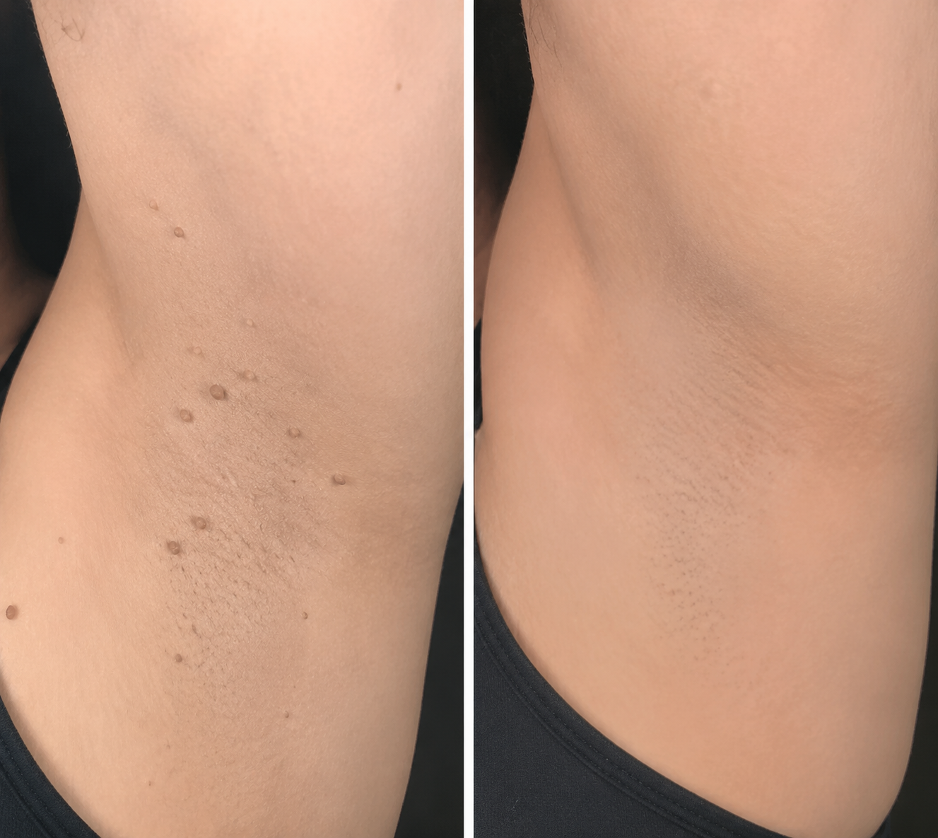 👉 PuraCure® 2 az 1-ben mikrotűs és hidrokolloid tapasz🧑‍⚕️ | Kiálló anyajegyek, aknék, lapos szemölcsök és bőrnövedékek eltávolítására | Segít csökkenteni a ráncokat, hegeket és bőrhibákat | Láthatatlan tapasz az arcra és testre