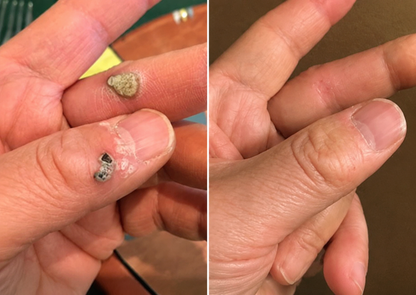 👉 PuraCure® 2 az 1-ben mikrotűs és hidrokolloid tapasz🧑‍⚕️ | Kiálló anyajegyek, aknék, lapos szemölcsök és bőrnövedékek eltávolítására | Segít csökkenteni a ráncokat, hegeket és bőrhibákat | Láthatatlan tapasz az arcra és testre